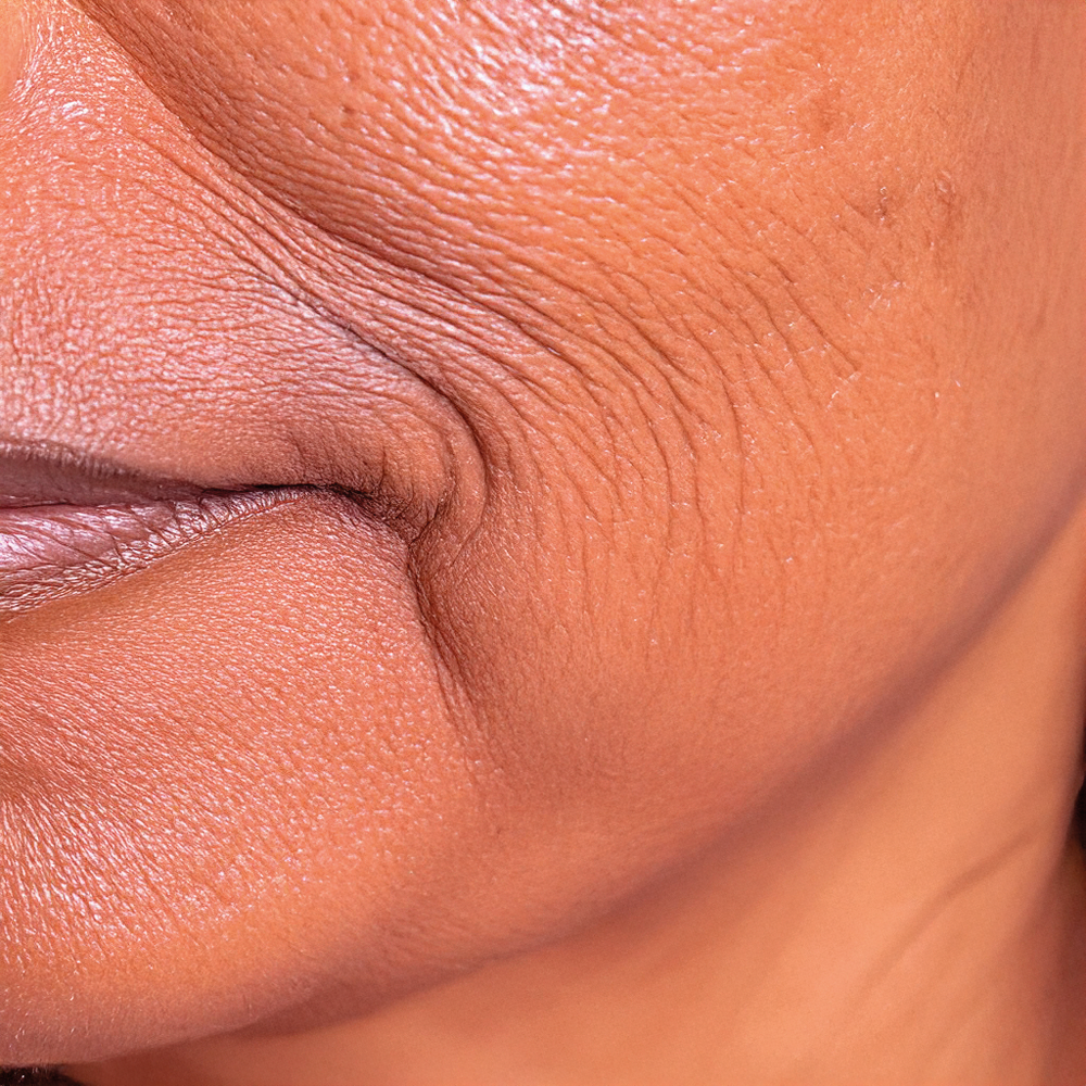 Dehydrated skin