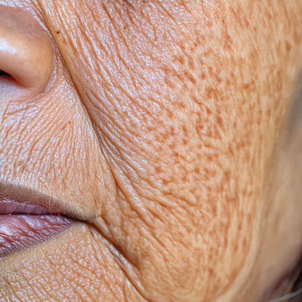 Excessively horny skin