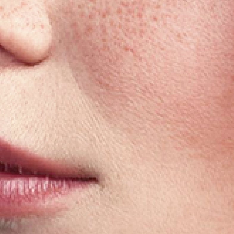 Sensitive skin