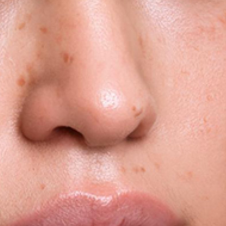 Irritated skin