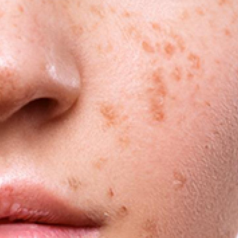 Problematic skin